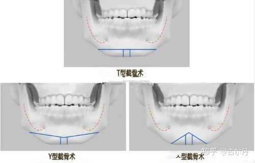 截骨頭示意圖